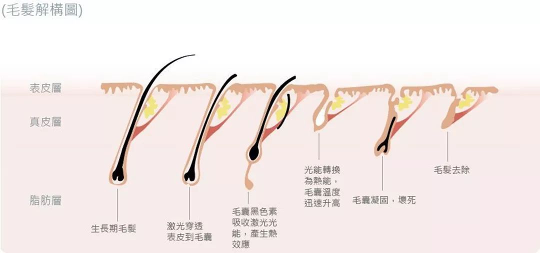 “白煮蛋”與“獼猴桃”之間，還差一個它 強脈沖脫毛器械，值得買嗎？